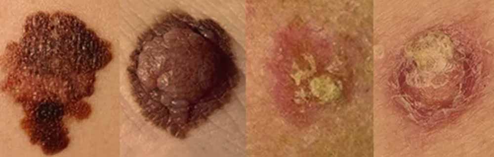 various-cancer-images